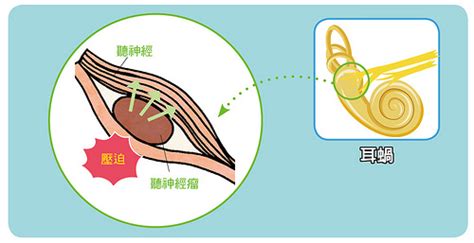 耳朵有聲音|耳鳴原因有3種，一直耳鳴怎麼辦？舒緩耳鳴症狀醫師。